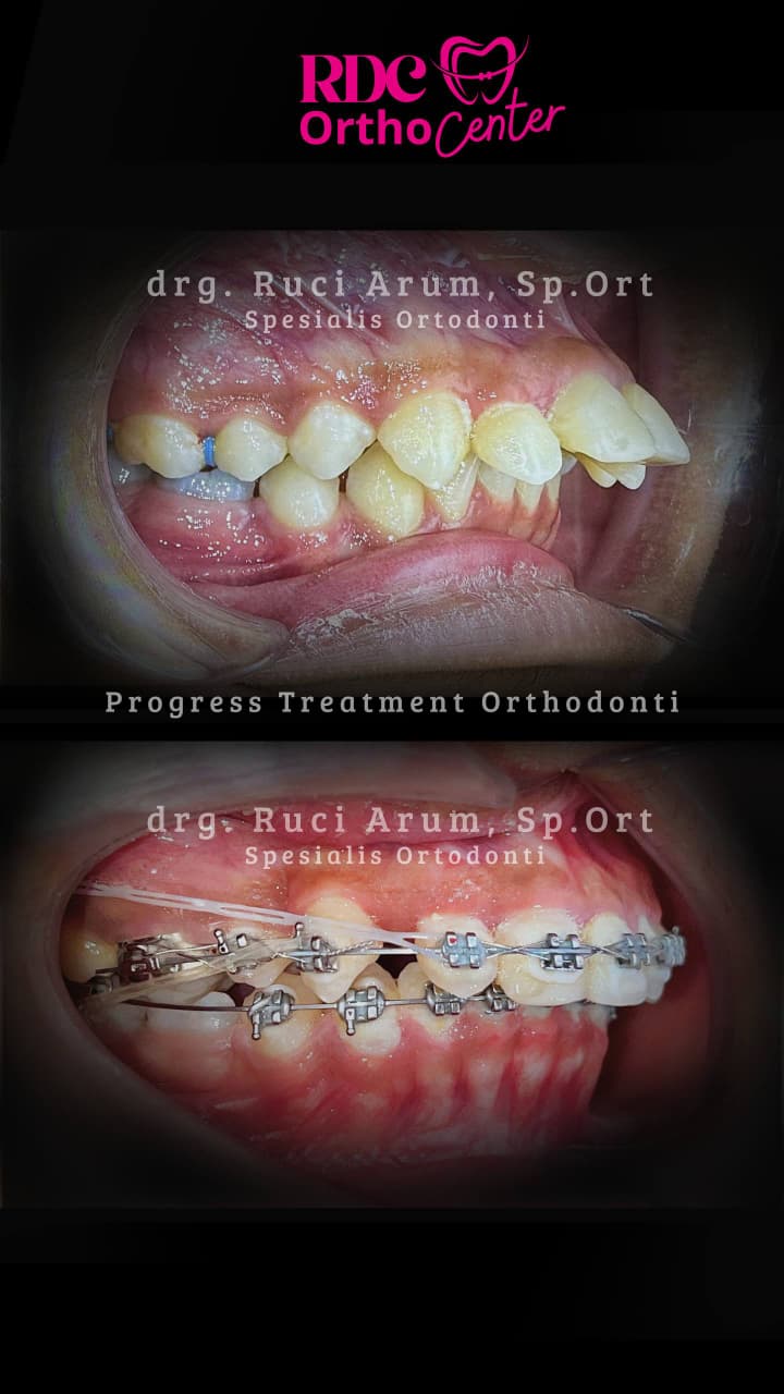 Behel Gigi / Ortodonti