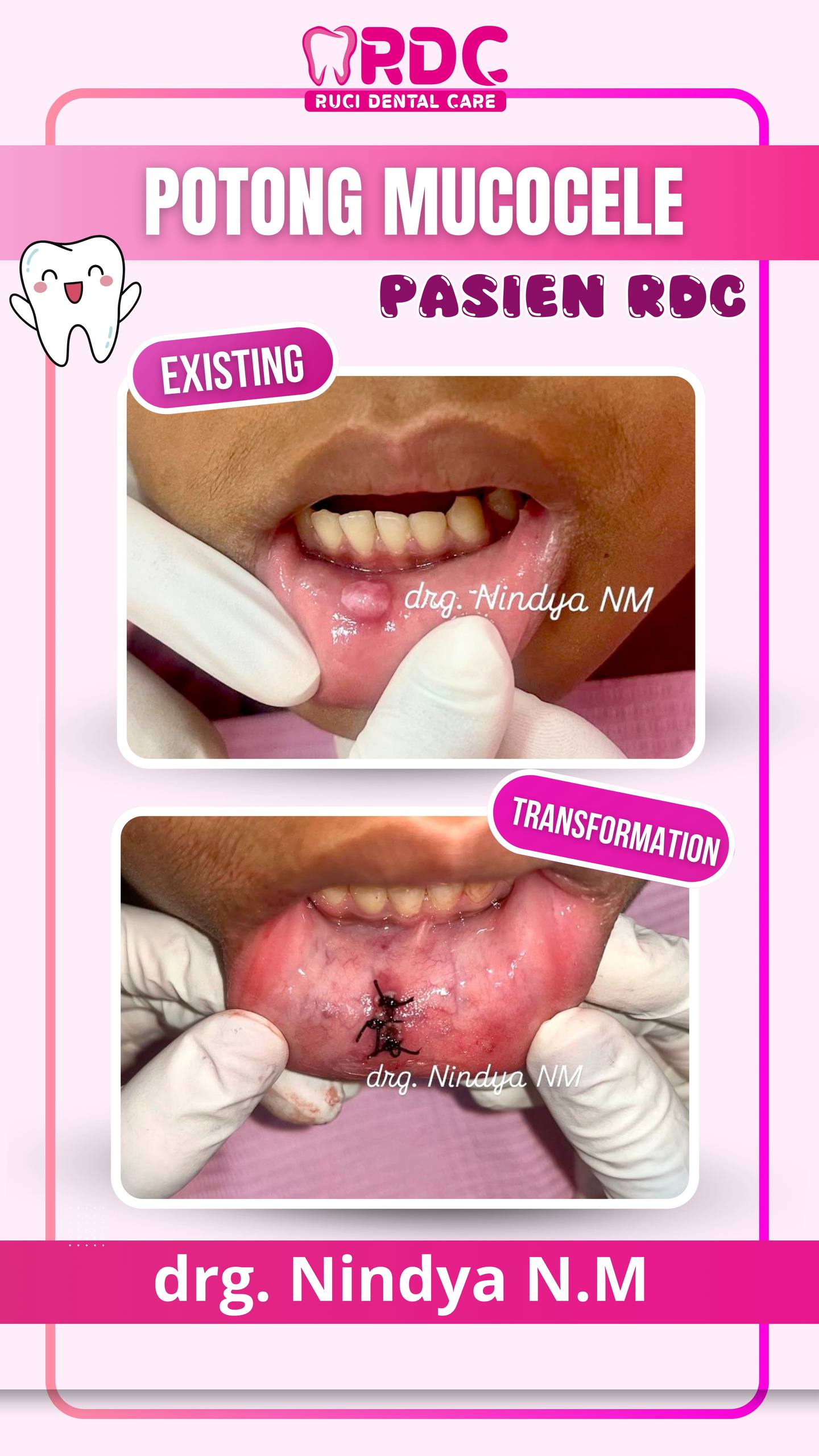 Mucocele