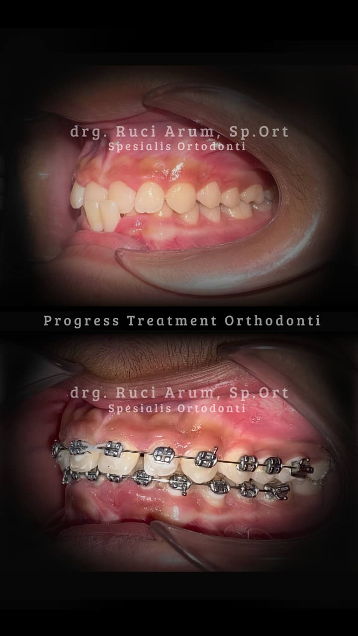 Behel Gigi / Ortodonti