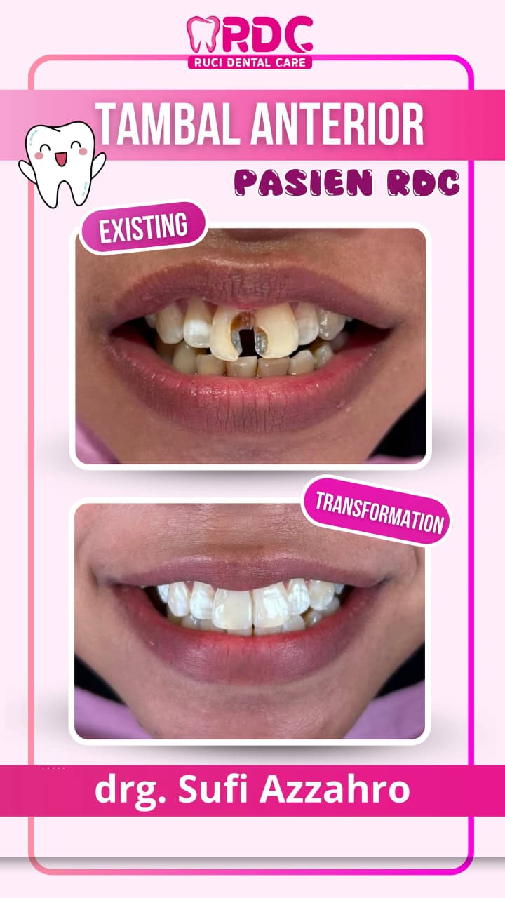 Tambal Gigi Anak / Dewasa