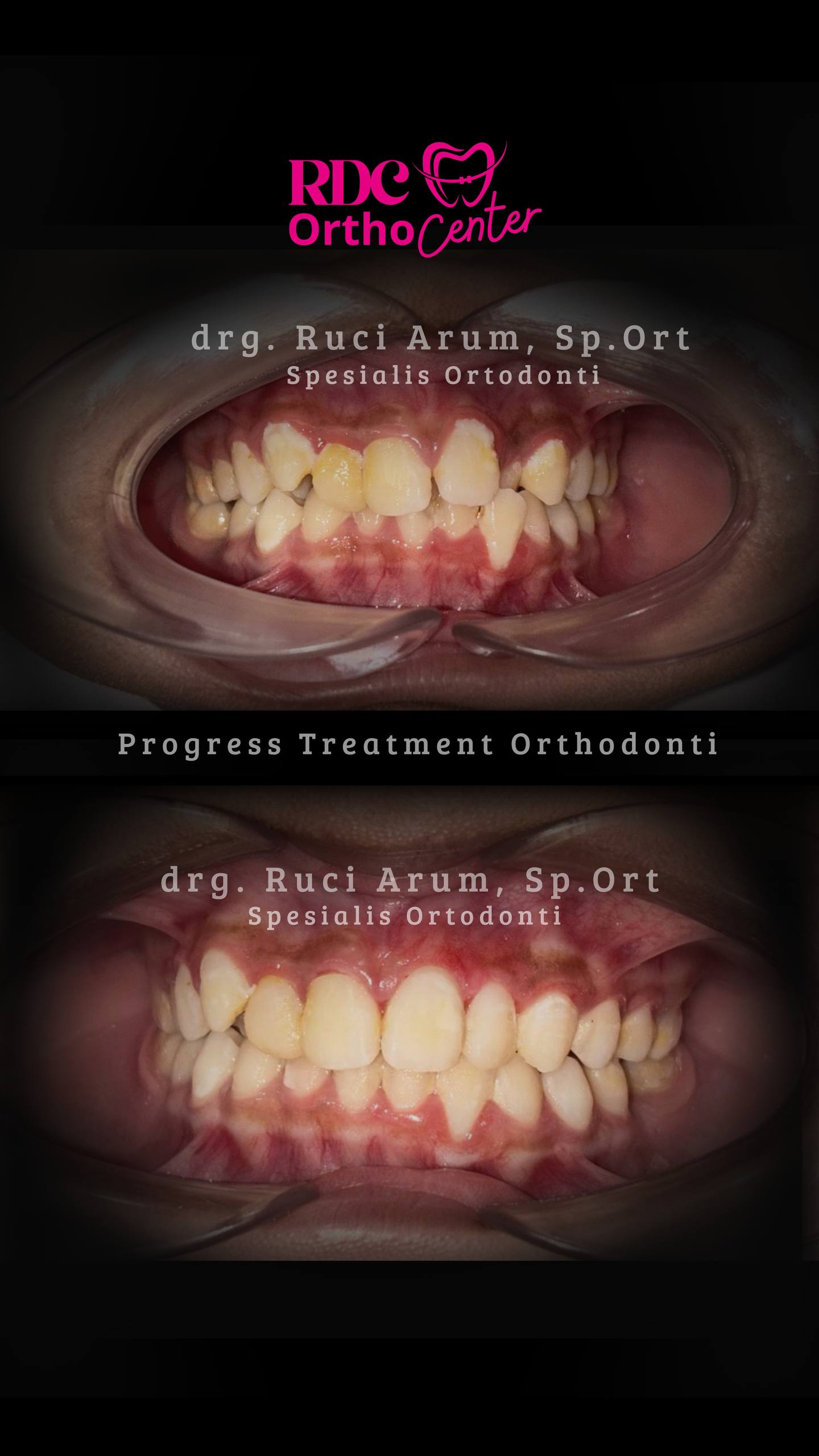 Behel Gigi / Ortodonti